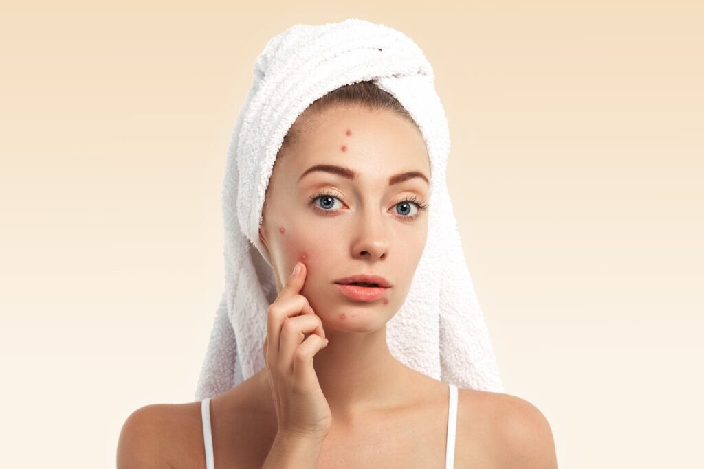 Imagem de uma mulher adulta olhando seu reflexo no espelho com expressão preocupada, tocando o rosto onde há algumas espinhas visíveis. A imagem representa a preocupação com a acne adulta e os desafios dos cuidados com a pele.
